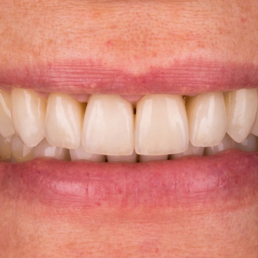 Restore a natural smile
